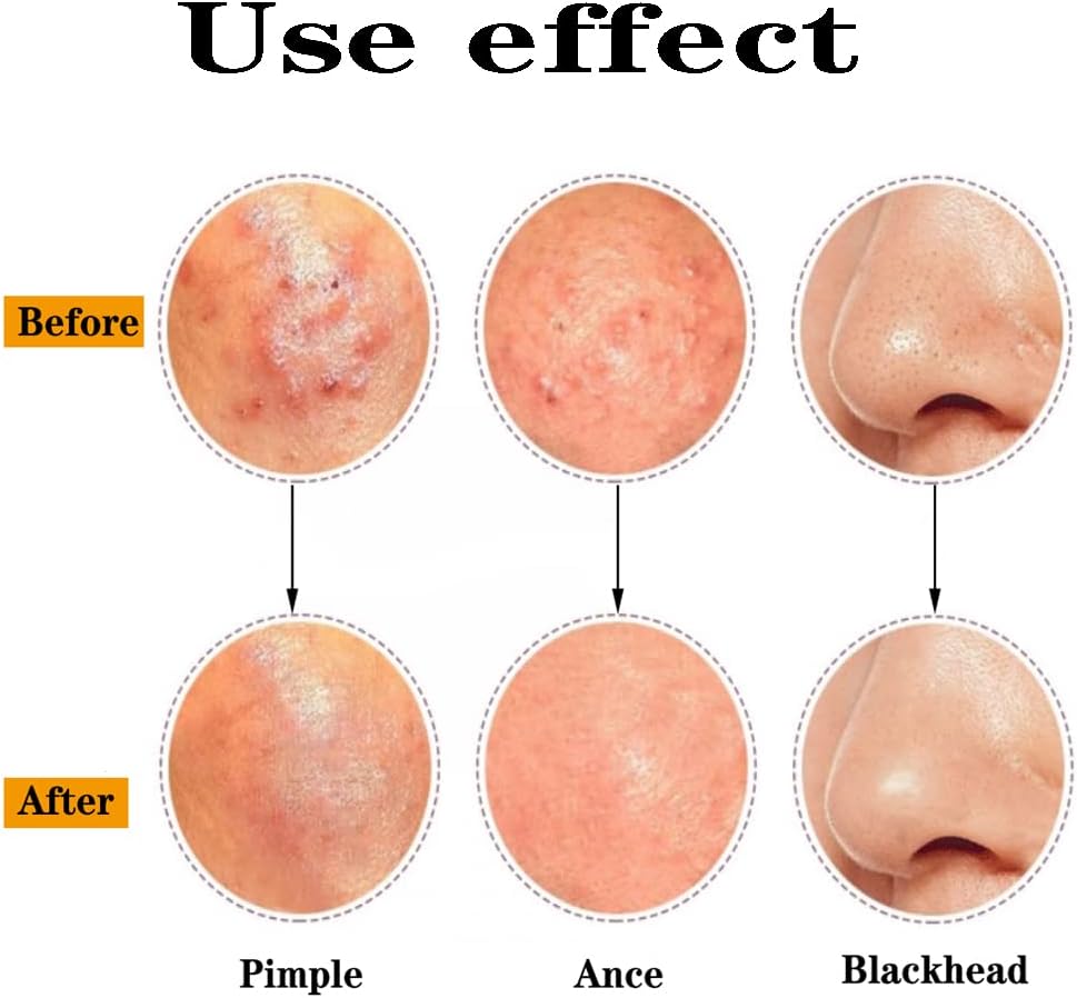 Professional Blackhead Remover Pimple Popper Tool,Comedones Extractor Acne Removal Tweezers for Blemishs,Whitehead Popping,Zit Removing for Nose Face,Stainless Steel Makeup Tool