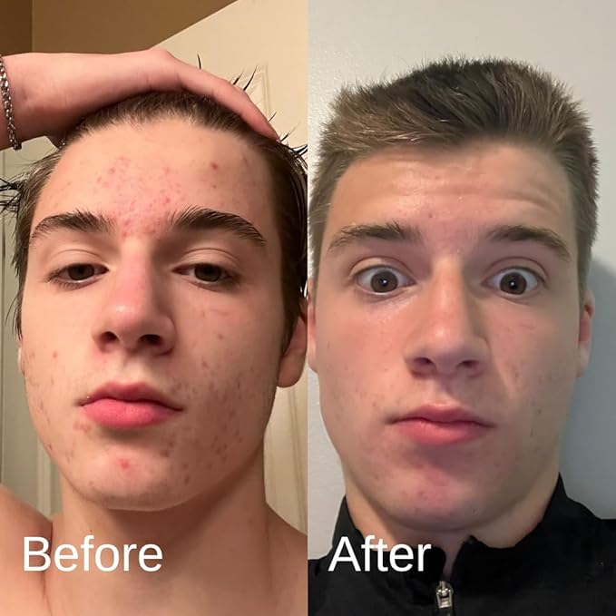 Acne System for Men and Boys, Face Wash, Moisturizer, Pimple Patches, Shield Men's Skin Care Set (2 Months)