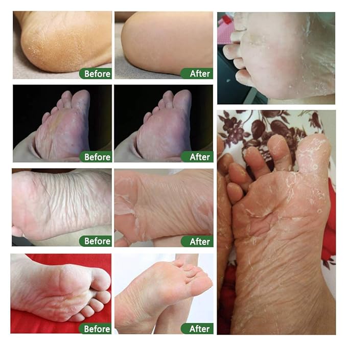 Foot Peel Mask 3 Pack, Exfoliator Peel Off Calluses Dead Skin Callus Remover,Soft Smooth Touch Feet-Men Women (Tea Tree)