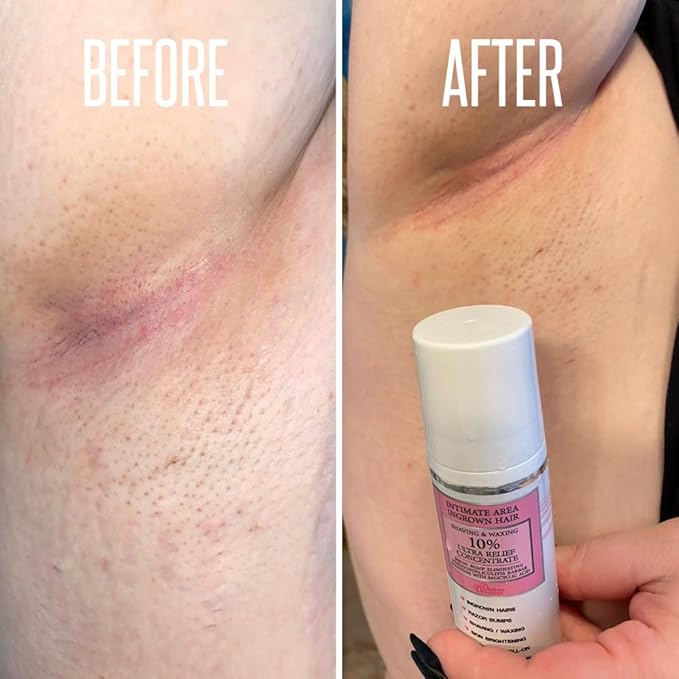 Save 14% on The Skin Care Solution For Dark Spots, Razor Bumps, Ingrown Hair & Razor Burns β Includes Our Ultra Potent Brightening + Razor Bumps Solution For an Ultra Clear & Glowing Skin