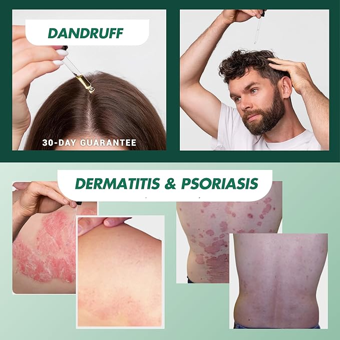 ABERA Alan Silver Serum - Clinically Proven to Soothe Irritated Skin and Improve The Appearance of Skin with Mild to Moderate Psoriasis (2 Boxes)