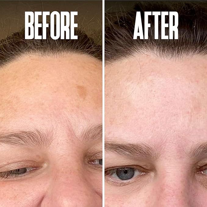 Save 14% on The Skin Care Solution For Dark Spots, Razor Bumps, Ingrown Hair & Razor Burns β Includes Our Ultra Potent Brightening + Razor Bumps Solution For an Ultra Clear & Glowing Skin