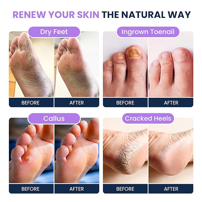 Soothing Lavender Foot Soak with Epsom Salt & Callus Remover for Feet with Extra Strength Gel & Foot Pumice Stone Set