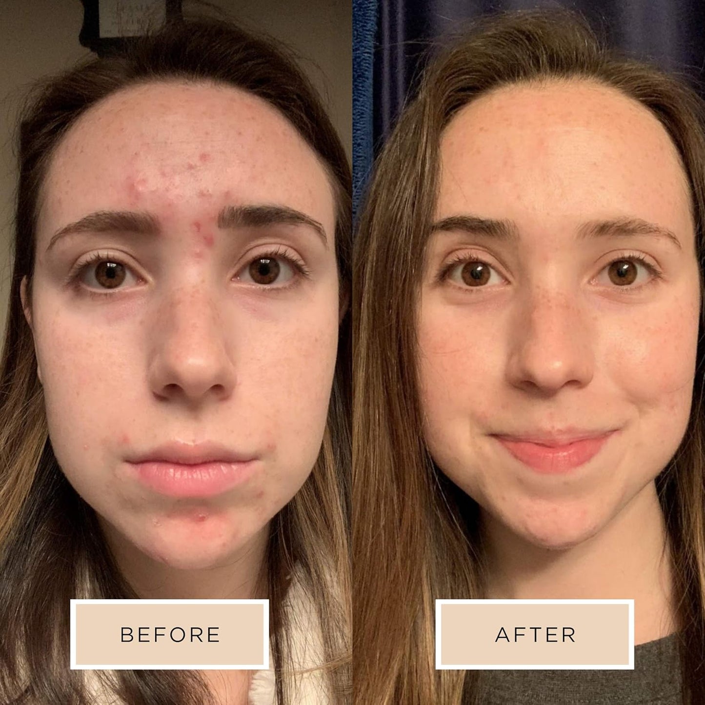 Averr Aglow - Clear Skin Kit - Acne Treatment - Dark Spot Remover - Blemish & Redness Control - Hydrating & Moisturizing - Rich in Minerals, Antioxidants & Vitamin A, C, D & E - Skin Care - 4 pc Set