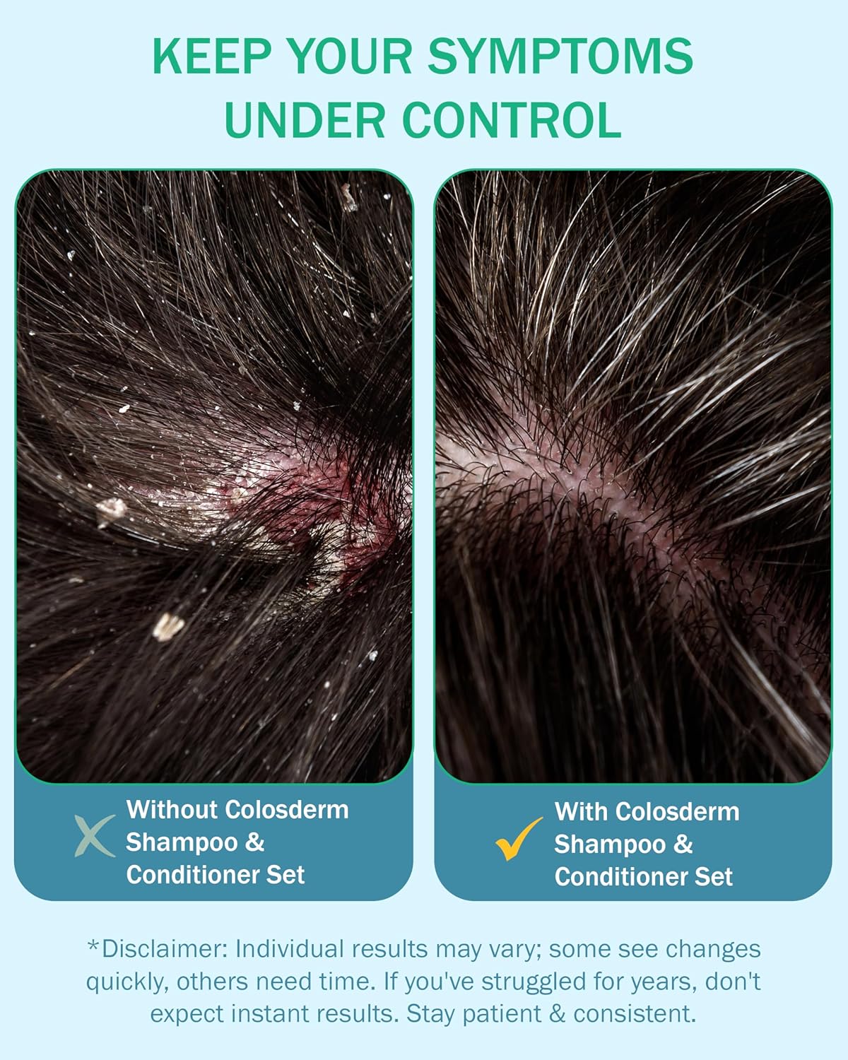 Eczema Cream Shampoo and Conditioner Scalp Treatment for Sensitive Skin for Kids & Adults- Colostrum & Colloidal Oatmeal -Itchy Scalp Anti Dandruff Shampoo for Women & Men, 16 fl oz, Made in USA