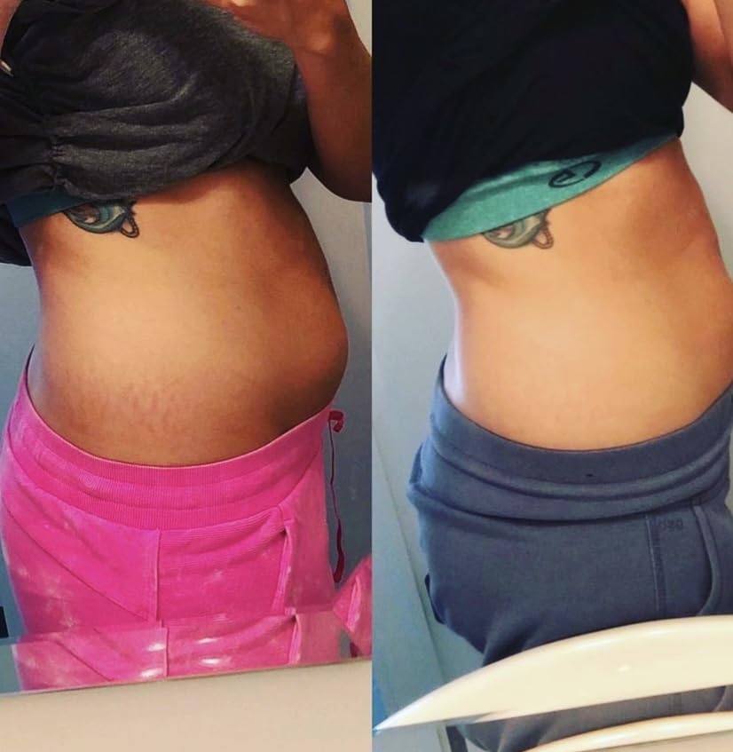 Promise Stretch Mark Prevention Kit, Scars and Dry Skin, Ultra-Hydrating Stretch Mark Cream and Stretch Mark Oil for Pregnant Women, Vegan, Non-Toxic, Set