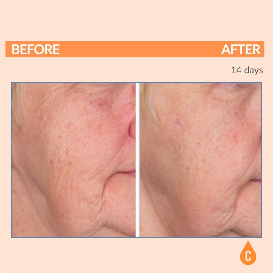 Serious Skincare Vitamin C Serum for Face, Anti-Aging Face Serum with Collagen, Vitamin E, Hydrating Skin Care for Brightening, Improve Appearance of Dark Spots, Tone, Fine Lines & Wrinkles 1 Fl Oz