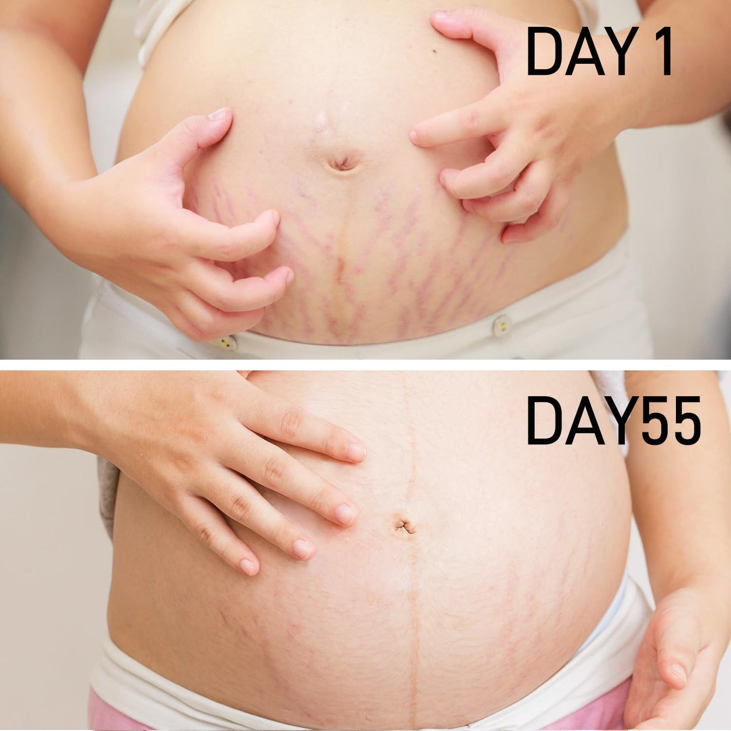 PEGO Stretch Mark Oil for Pregnancy, Maternity Body Oil for Stretch Mark Prevention & Reduction, Hydrating Skin Care, 2.03oz (1Pack)