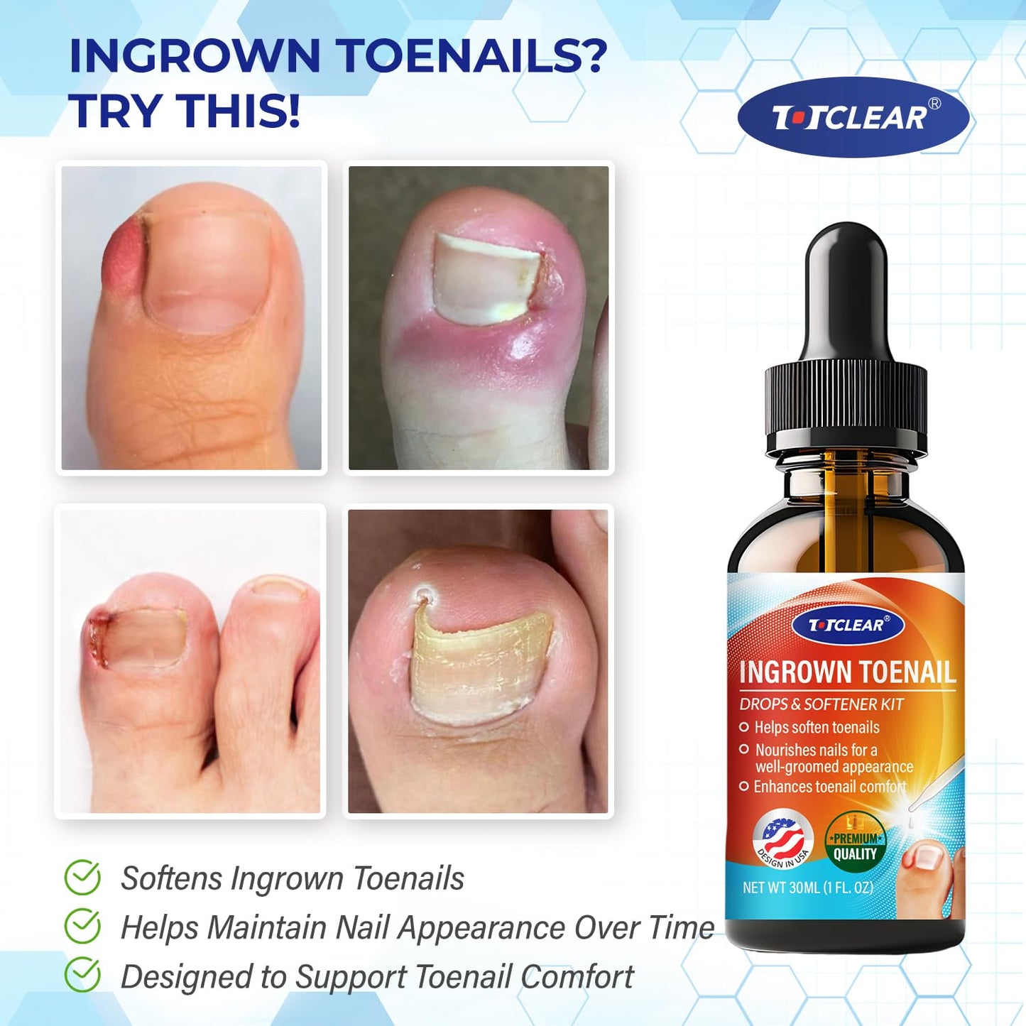 Ingrown Toenail Relief: Ingrown Toenail Tool for Men Women - Ingrown Toenail Removal Kit - Ingrown Toenail Corrector Drops - Ingrown Toenail Removal - Effective Solution for Ingrown Toenails - 30ml