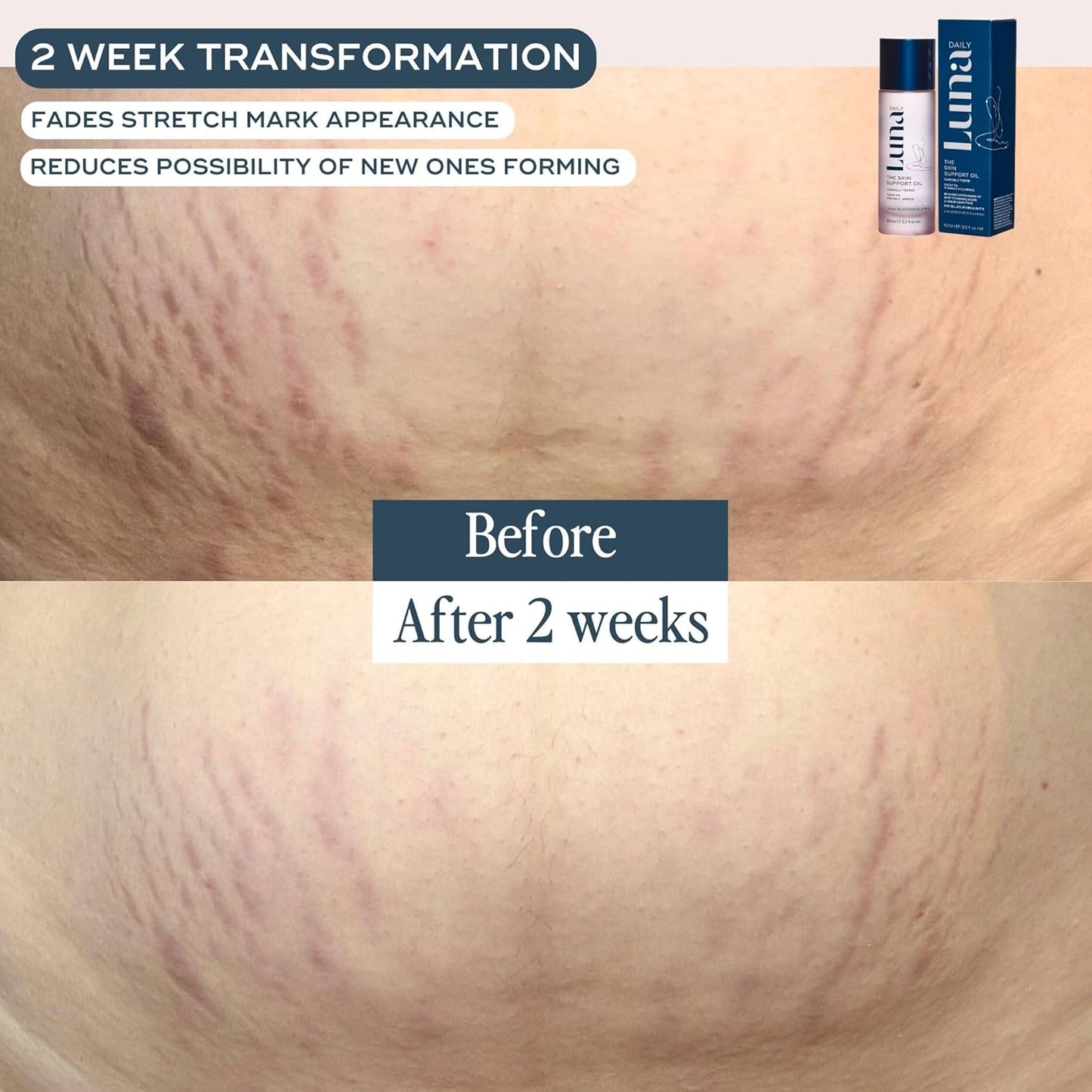 Luna Daily Stretch Mark Body Oil | Hydrating Treatment for Scars, Discoloration & Uneven Skin Texture | Vitamin C & Coconut Oil Nourish Dry Skin | Clinically Proven, Pregnancy Safe for Women, 300ml