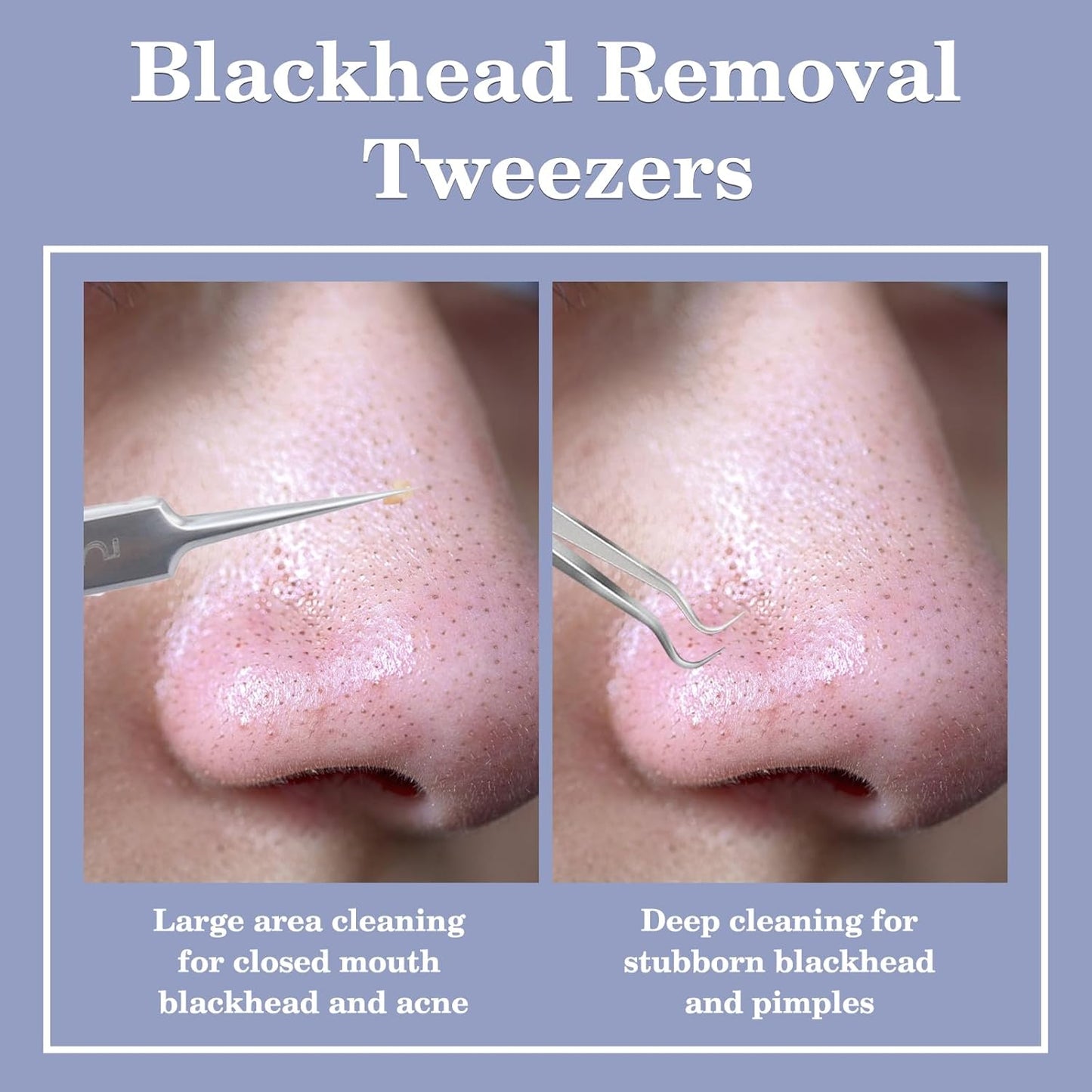 WSYUB Blackhead Tweezers,Ingrown Hair Tweezers,Pimple Popper Tool Kit,Acne Needle Tool, Blackhead Extractor,Eyebrows Facial Hair Razors