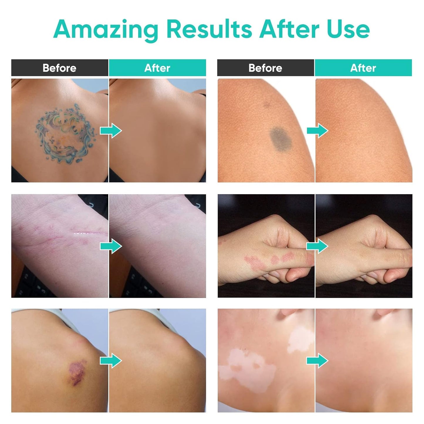 Tattoo Cover Up Makeup Waterproof, 2 Color Long Lasting Tattoo Concealer for Body, Covers Scars, Vitiligo, Dark Spots, Waterproof & Sweatproof