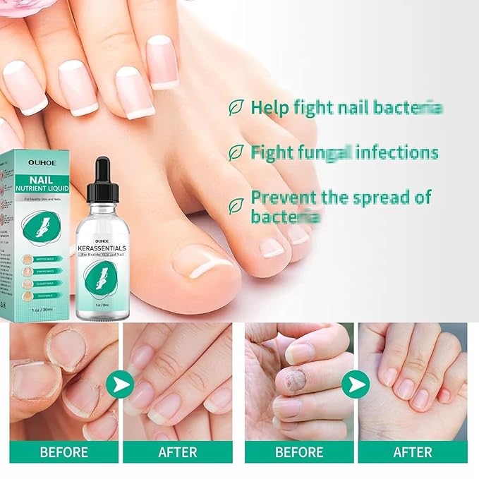 Kerassentials Toenail Oil, Kerassentials Nails Nutrient Oil, Nail Repair Solution 30ML/1PCS (4PCS)
