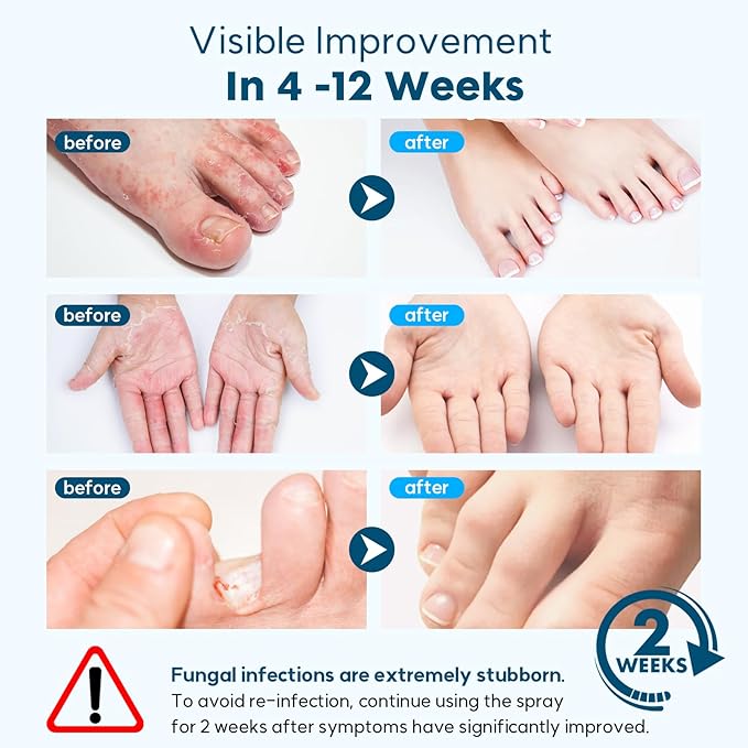 Athletes Foot Treatment, Natural Herbal Athletes Foot Spray for Most Athlete's Foot and Treat Symptoms of Molting, Blisters, Itching and Odor. (2Pcs, Fresh)