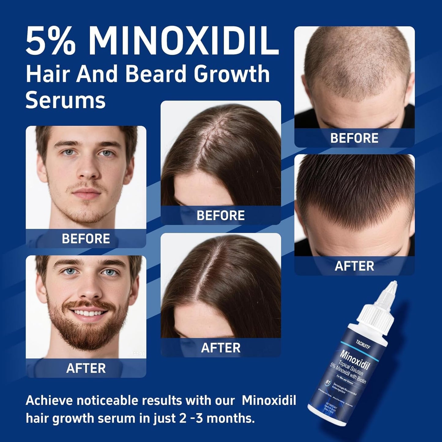 6 Packs, 5% Minoxidil with Biotin, Hair Growth Treatment, Minoxidil Hair and Beard Growth Oil, Minoxidil for Men and Women, Supports Thicker and Fuller Hair & Beard (12 fl oz, 6 Month Supply)