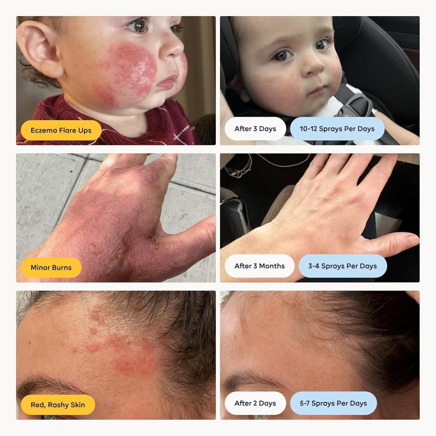 Magic Molecule Hypochlorous Acid Spray for Breakout-Prone Skin, Eczema & Itchy Rashes | Helps 50+ Dermal Issues | for All Skin Types 3.4 oz (Pack of 2) Travel-Friendly