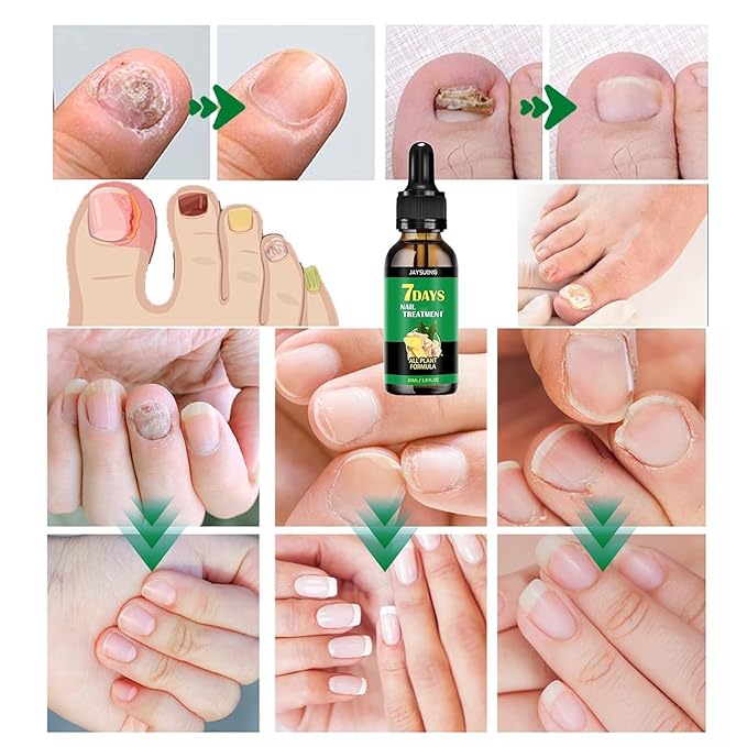 Ginger Nail Growth Serum, 7 Days Nail Treatment, Ginger Nail Treatment, Ginger Cuticle Care Oil for Strengthen & Promote Nail Growth (2Pcs)