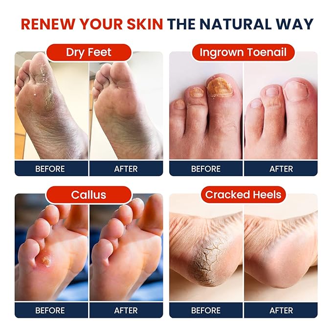 Toenail Repair Pedicure Kit with Muscle Relief Foot Soak with Epsom Salts - All Natural Salts for Post Workout Recovery - Softens Calluses - Soothes Sore Tired Feet