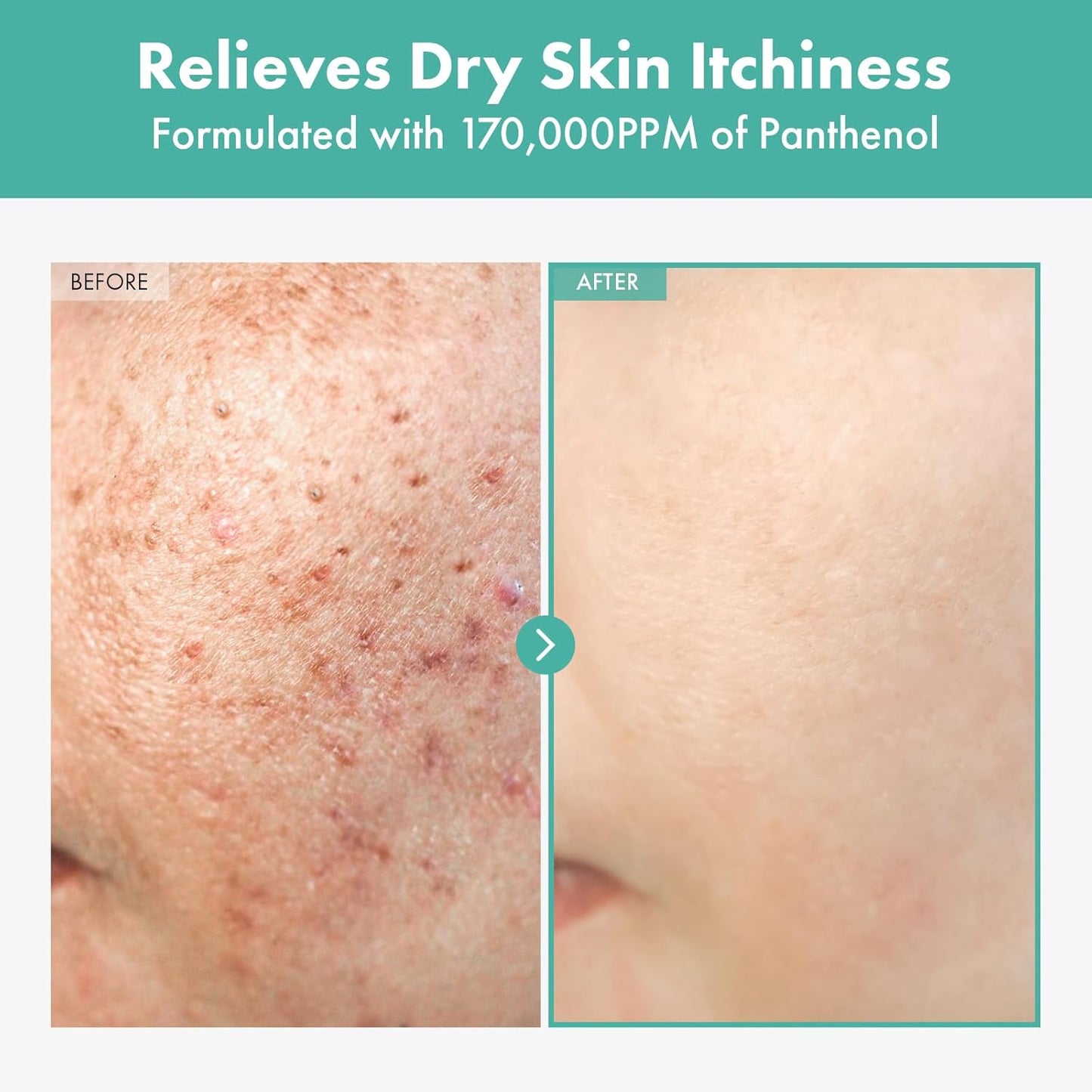 TOSOWOONG Dexpanthenol Cream, 170,000ppm B5 Panthenol, Madecassoside, Centella Asiatica for Skin Barrier Repair, Facial Moisturizer, Soothing, Hydrating, Korean Skincare, 60ml, 2.02 fl. oz.