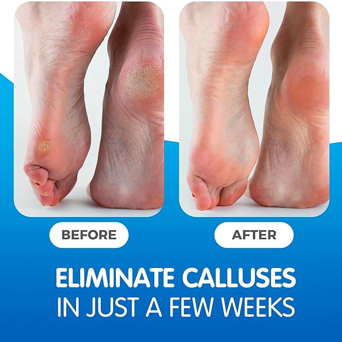 PEDICURE GRADE Foot Masks that Remove Dead Skin | Smooth and Soften foot peel mask for dry cracked feet Premium | Foot Callus Removal For Feet Gel | Imperial Feet