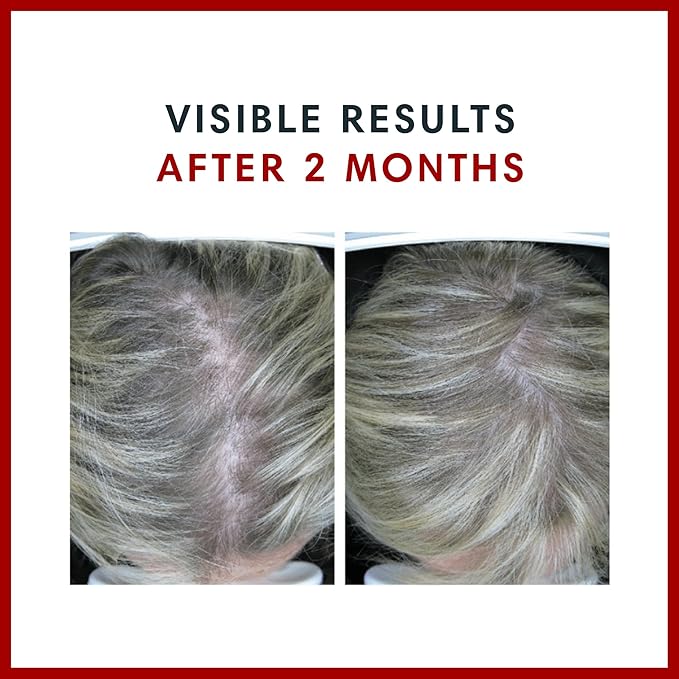 Consult Health BIOTIN GAIN Gummies with ANAGAIN - Reduce Hair Loss - Clinically Tested - 10,000 mcg Biotin Vitamin B7 to Support Healthy Hair Growth, Skin and Nails for Women and Men - 60 Count