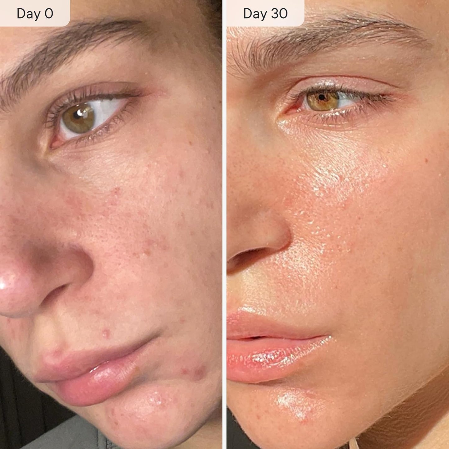 Qure Micro Infusion System for Face & Neck - Facial Moisturizing Essence, Hydrating Serum for All Skin Types, Refreshed Skin - 5-Month Supply