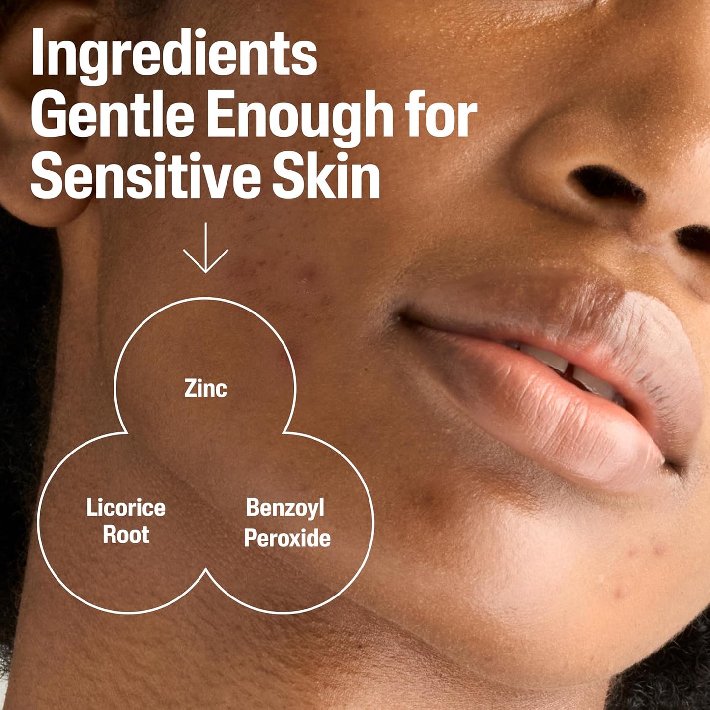 Cetaphil Gentle Clear Complexion-Clearing BPO Acne Cleanser with 2.6% Benzoyl Peroxide, Creamy and Soothing for Sensitive Skin, Suitable for All Skin Types, 4.2oz