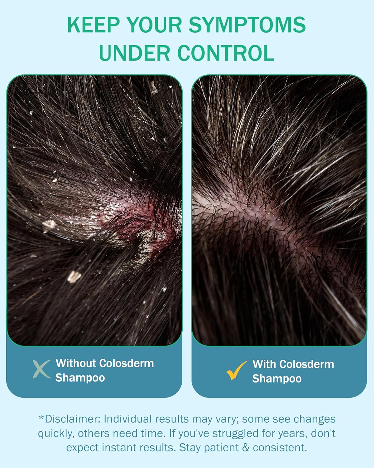 Eczema Cream Shampoo Treatment for Sensitive Skin for Kids & Adults- Colostrum & Colloidal Oatmeal -Itchy Scalp Anti Dandruff Eczema Shampoo for Scalp Women & Men, 16 fl oz, Made in USA