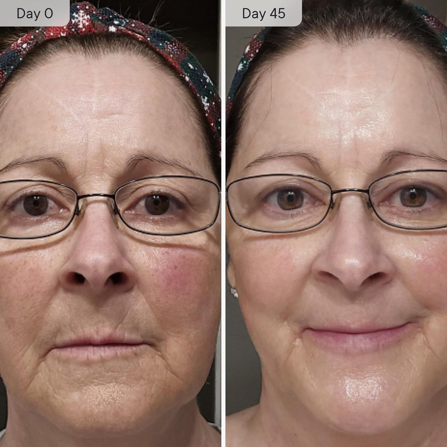 Qure Micro Infusion System for Face & Neck - Facial Moisturizing Essence, Hydrating Serum for All Skin Types, Refreshed Skin - 5-Month Supply